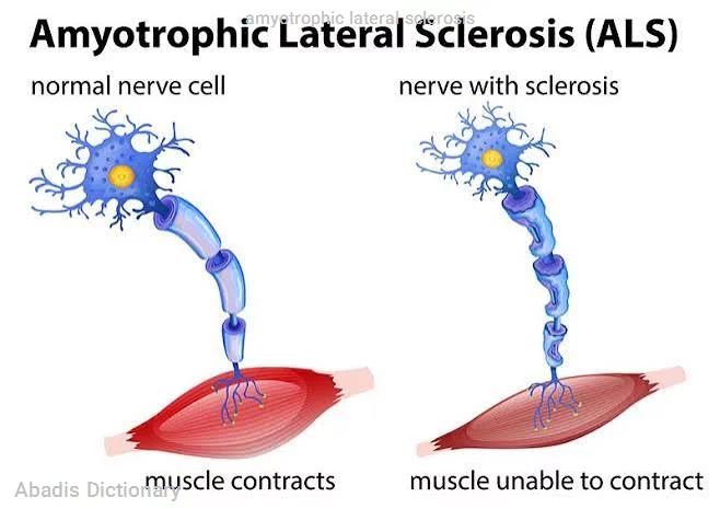 amyotrophic lateral sclerosis